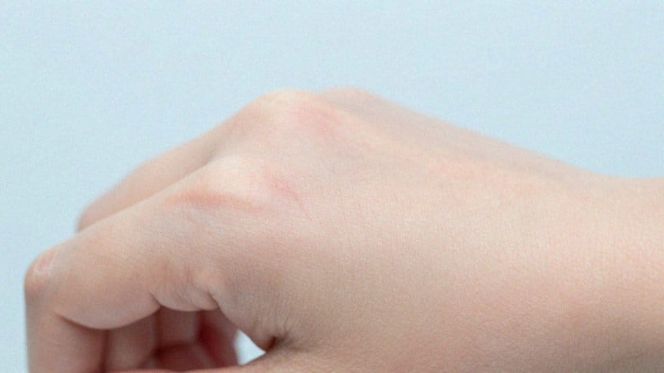 Jakie są skutki uboczne maści sterydowych przy łuszczycy?