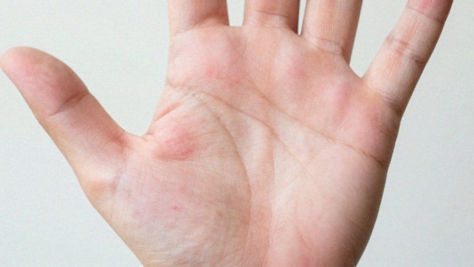 Jakie są objawy i postacie łuszczycy krostkowej?